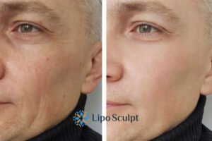 How to Fight Aging Symptoms 3 Fight Aging Symptoms Kings Langley With HIFU and Morpheus8 Today!