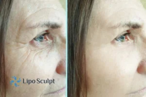 How to Fight Aging Symptoms 2 Do you want to Fight Aging Symptoms Kings Langley? Contact Lipo Sculpt today!