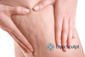 CoolSculpting for Legs: The Innovative Approach to Redefining Your Legs 5 Start your journey today book your coolsculpting treatment Kings Langley online today!