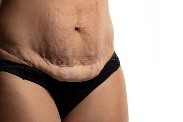 Lost the Weight but Not the Loose Skin? 1 image of womans stomach after weight loss showing loose skin Kings Langley